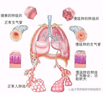 慢阻肺其中一个重要的临床表型就是肺气肿（俗称肺大疱），此类表型的患