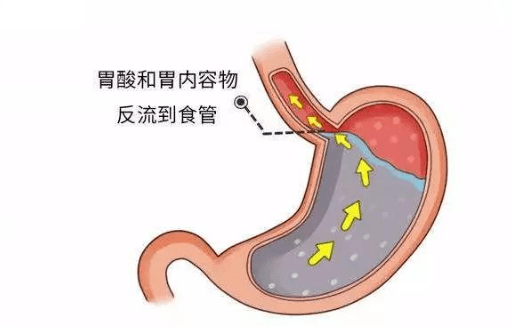 反酸是什么?经常胃酸反流是哪些原因导致的? - 希洛施泮托拉唑钠肠溶片