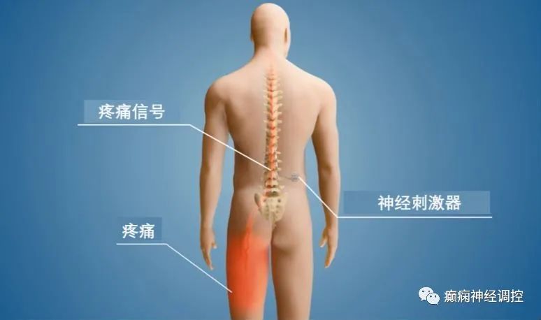 寻找治愈之路，脊髓电刺激治疗带状疱疹后遗神经痛