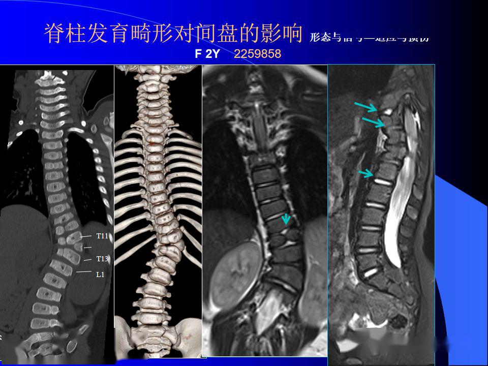 椎间盘发育退变与病变mri表现