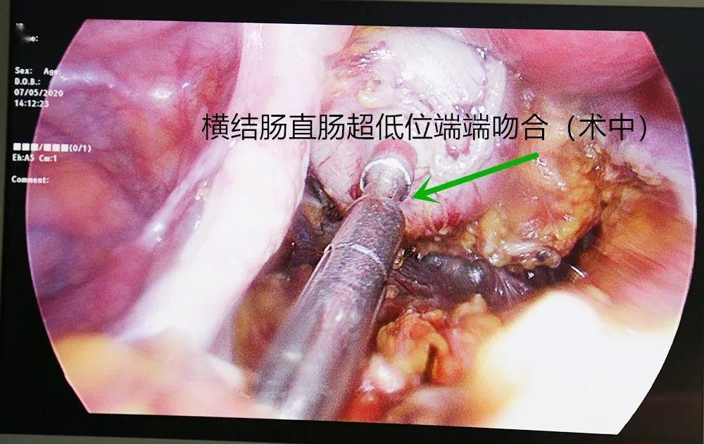 手术的安全性高,如:神经的显露更清晰,更好的排尿功能,性功能保护;更