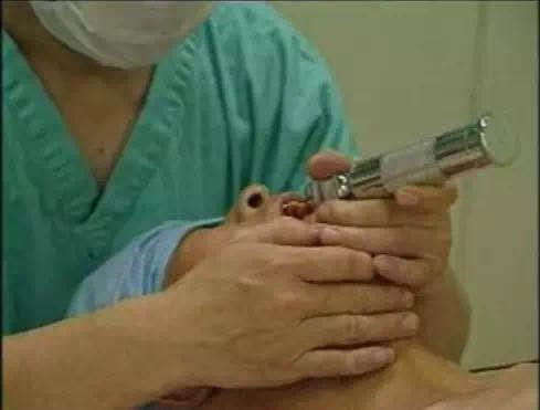 死地只有一招可以破解！脑组织被挤变形？这种快速置人于死地的危重状态