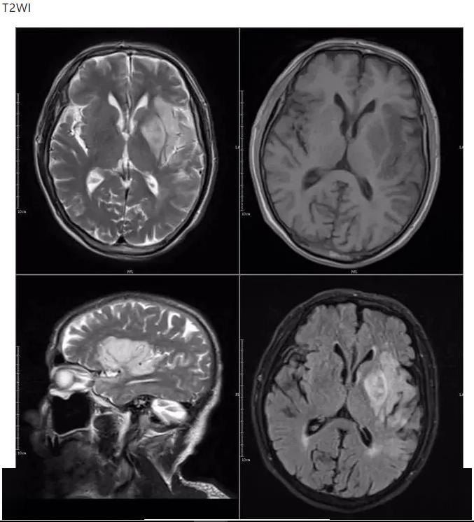 超急性期大面积脑梗死 ct 平扫表现