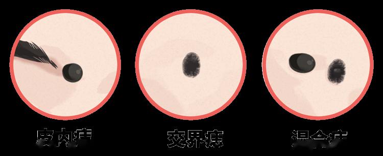 痣也有可能会癌变出现这些症状要当心