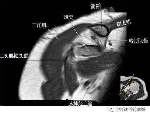 断层解剖 | 肩关节磁共振