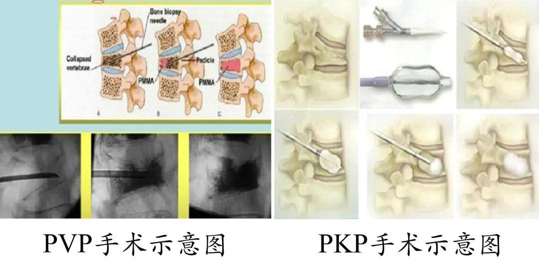 您的年龄>40岁; 手术治疗:随着微创技术的发展,经皮穿刺椎体成形术
