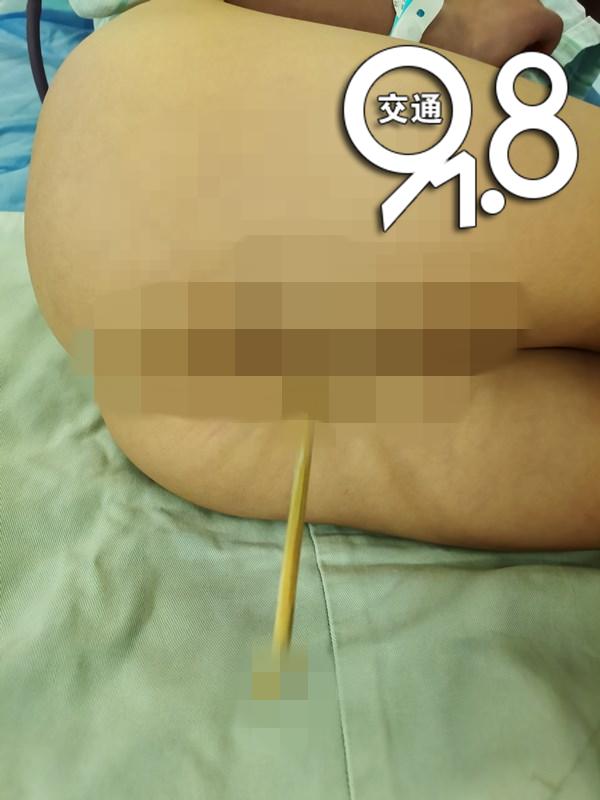 「小菲」抱来时……家长千万要注意3岁女童被竹签刺入