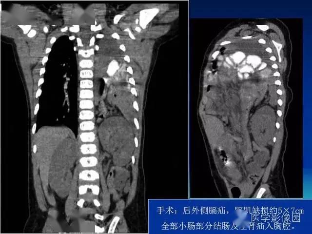 膈疝影像学表现