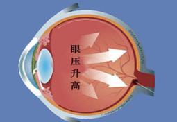 高眼压症的诊断与治疗_研究