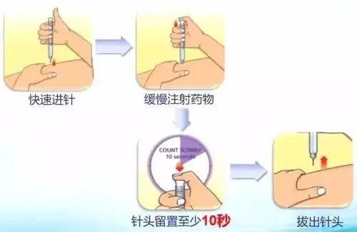 防止漏液: 注射完毕,针头留置在皮下10 秒以上,拔针后及时卸下针头.