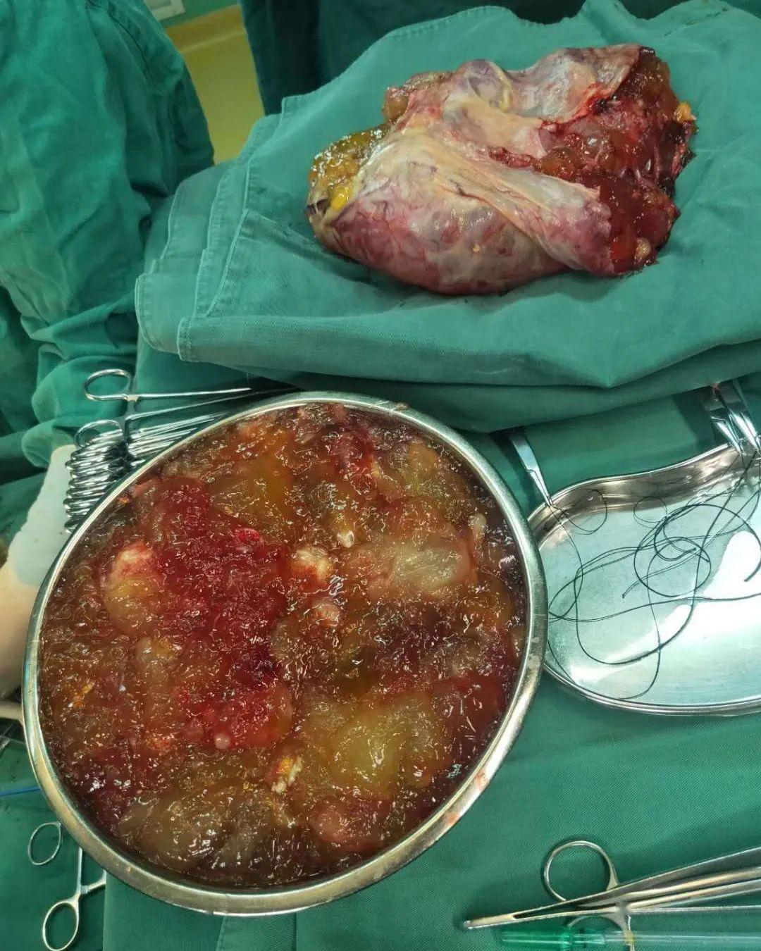 盆腔巨大肿瘤切除术 双附件切除术术中 手术过程顺利,清除彻底,出血