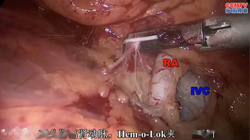 手术演示丨解剖性后腹腔镜根治性右肾切除术