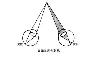 视光技术 | 矫正屈光参差的方法及5种不同情况的配镜原则