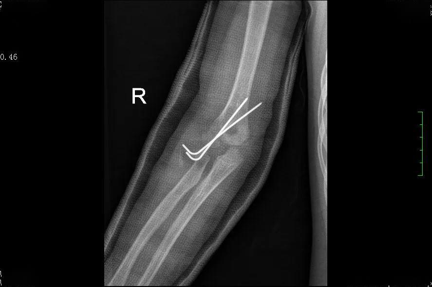 ▲右侧肱骨外髁骨折闭合复位克氏针固定及石膏固定术后。“幸亏在掉落的