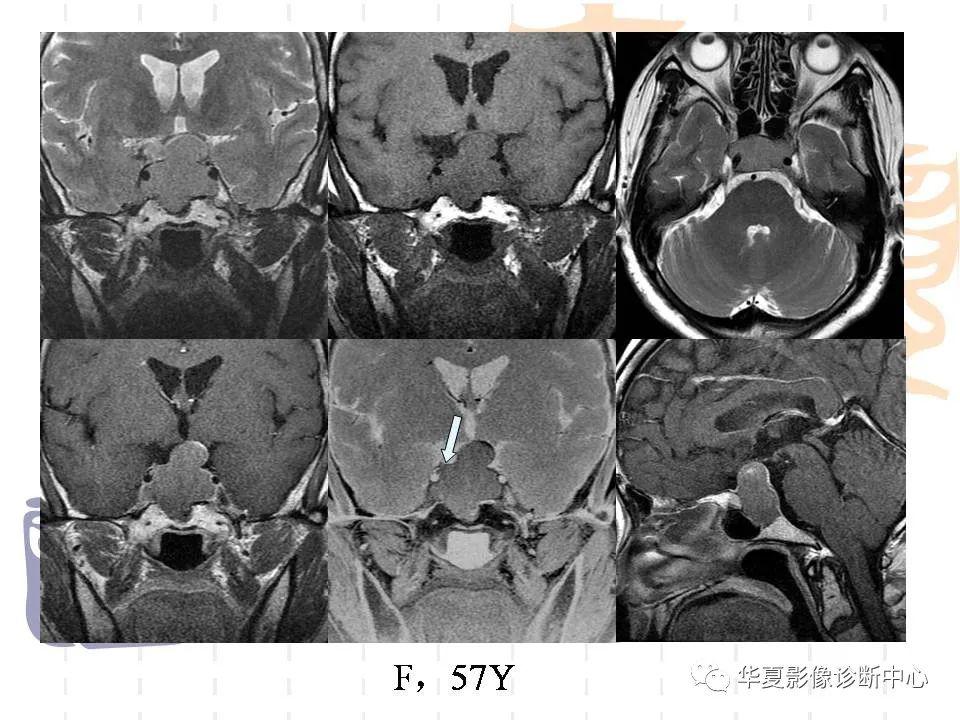 侵袭性垂体瘤的mri 征象