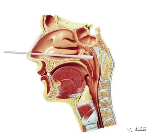 核酸检测之咽拭子采集方法