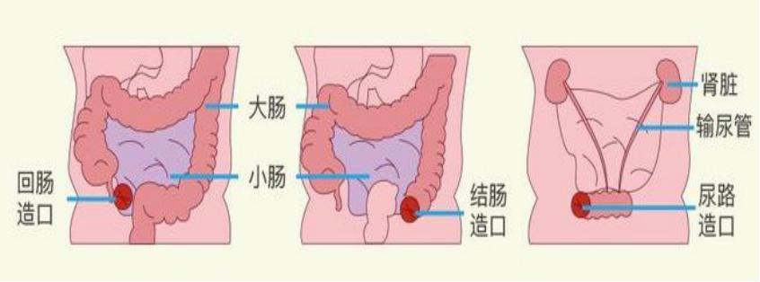 2,胃造口,肠造口,泌尿造口并发症的专业处理.