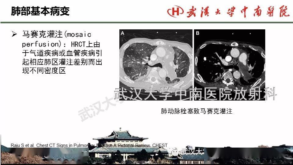 肺部影像解剖及基本概念,基本病变