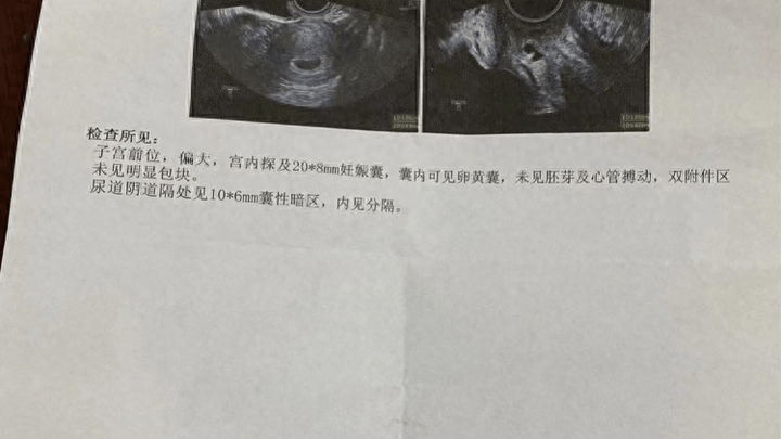 女子称b超未查出怀孕被开禁服药导致打胎,医院有责任吗?