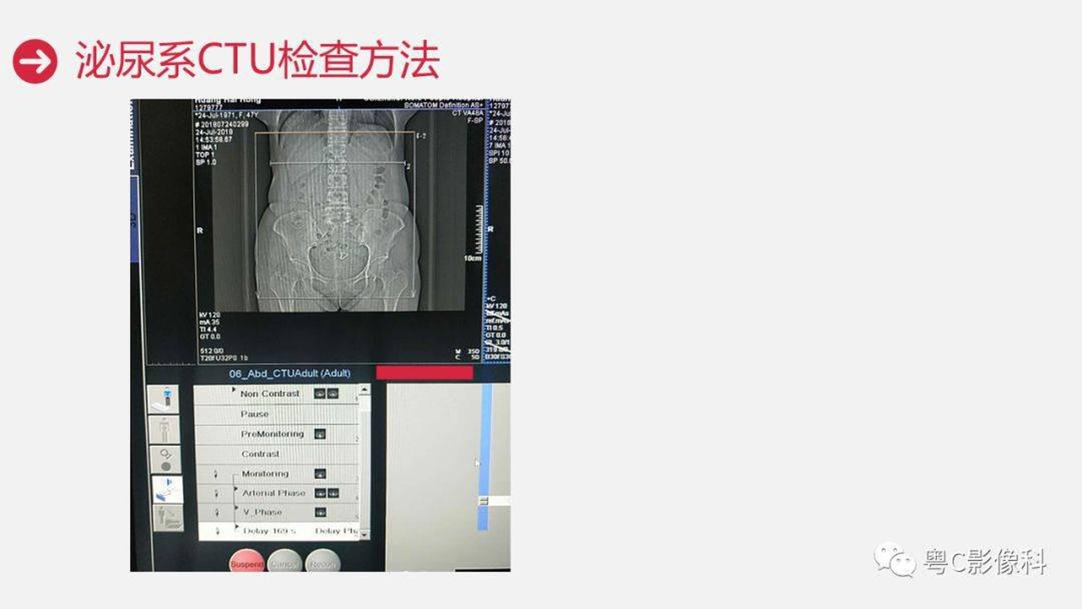 泌尿系ctu扫描技术