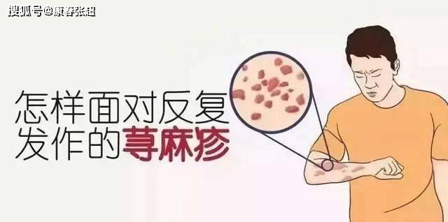 怎么样面对反复发作的荨麻疹?能否不留根?