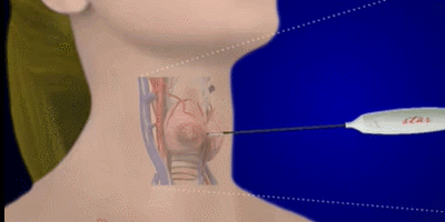超微创甲状腺微波消融术,治疗甲状腺结节,不开刀,美观不留疤