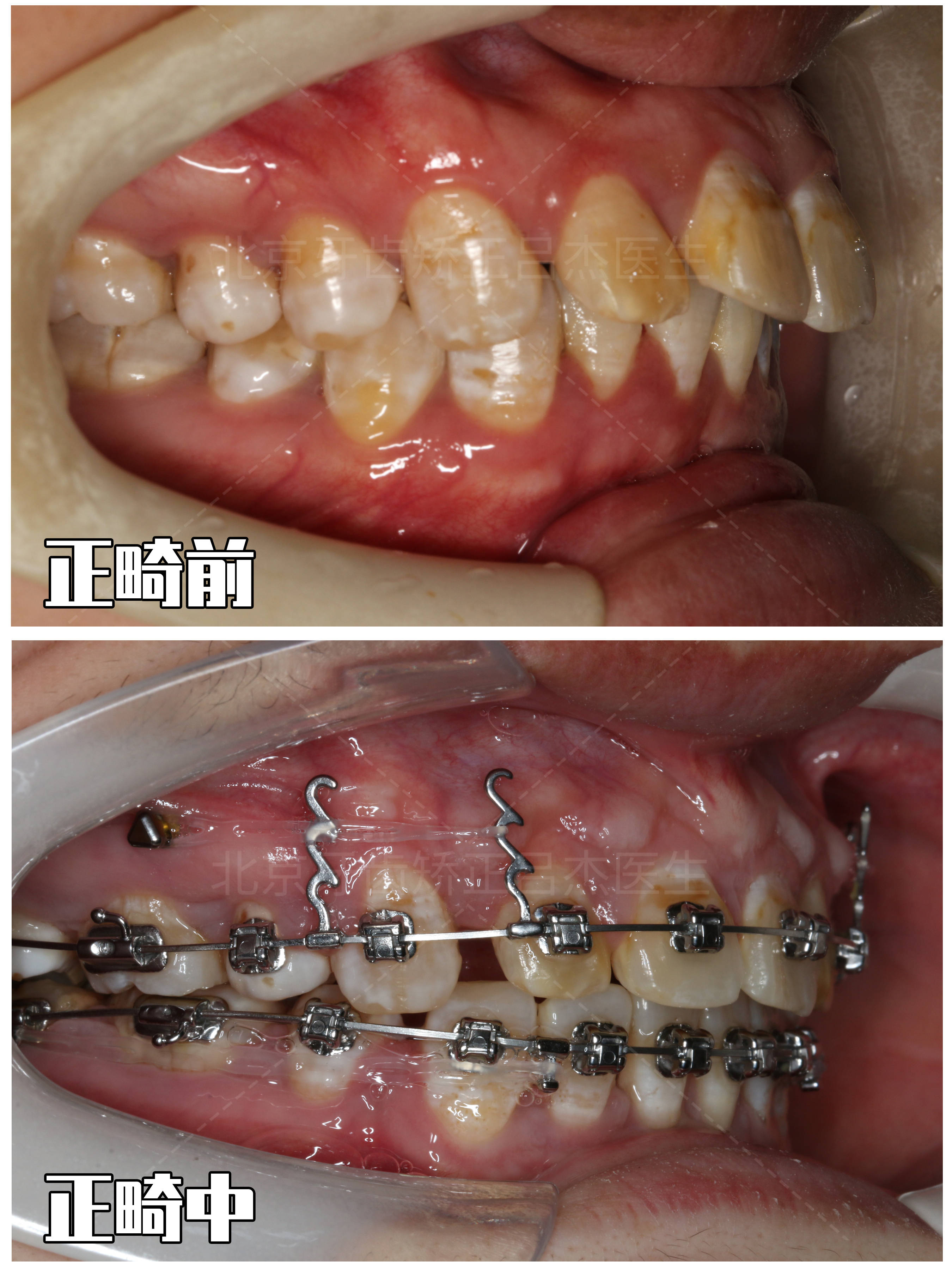 北京牙齿矫正,双颌严重前突,还牙根短,怎么进行正畸?