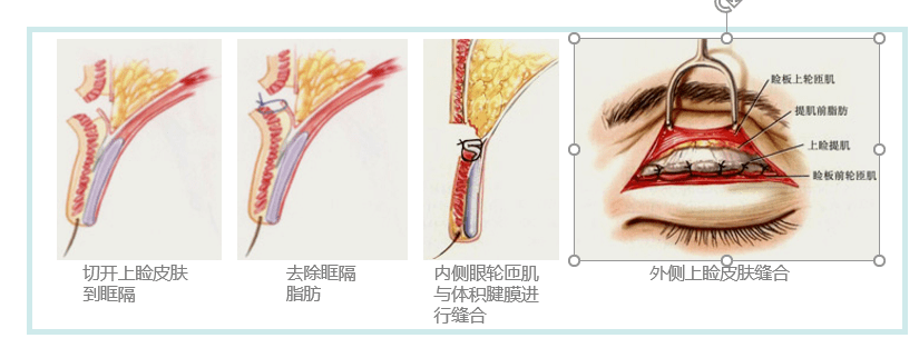 太原美眼王子杨民锋院长大刀阔斧的讲解各种双眼皮的术式优势