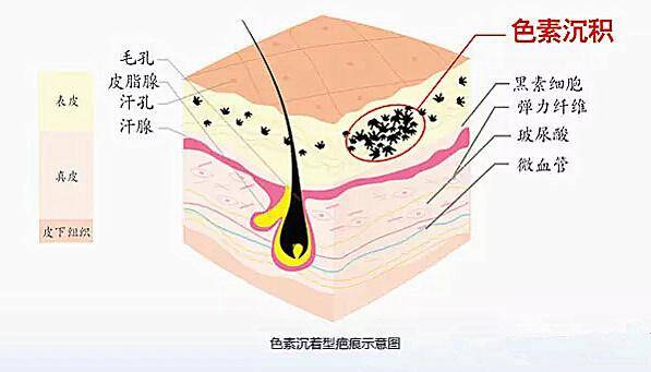 如何让色素沉着疤痕消退?