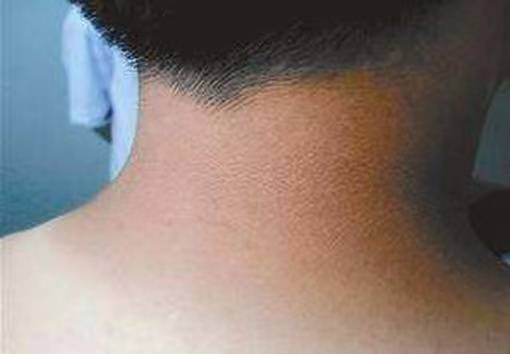 黑棘皮,它本身并不是一种疾病,而是一种黑色素沉淀引起的皮肤异常状况