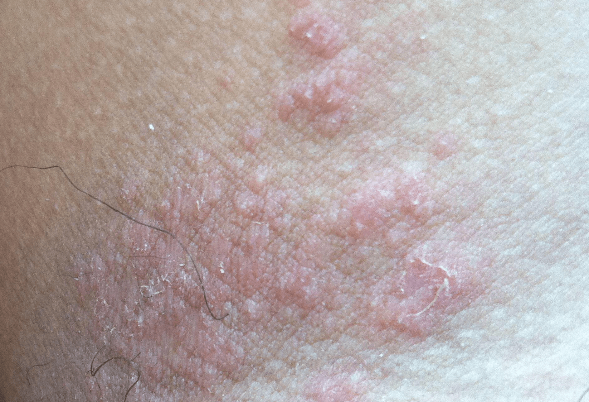 长春肤康医院浅谈湿疹易发于哪些部位有传染性吗