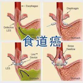 食道癌怎么治疗nk细胞治疗食道癌有效果吗