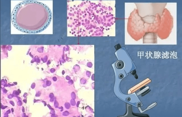 我们甲状腺的滤泡上皮和内分泌细胞的,而甲状腺恶性肿瘤除了癌以外,还
