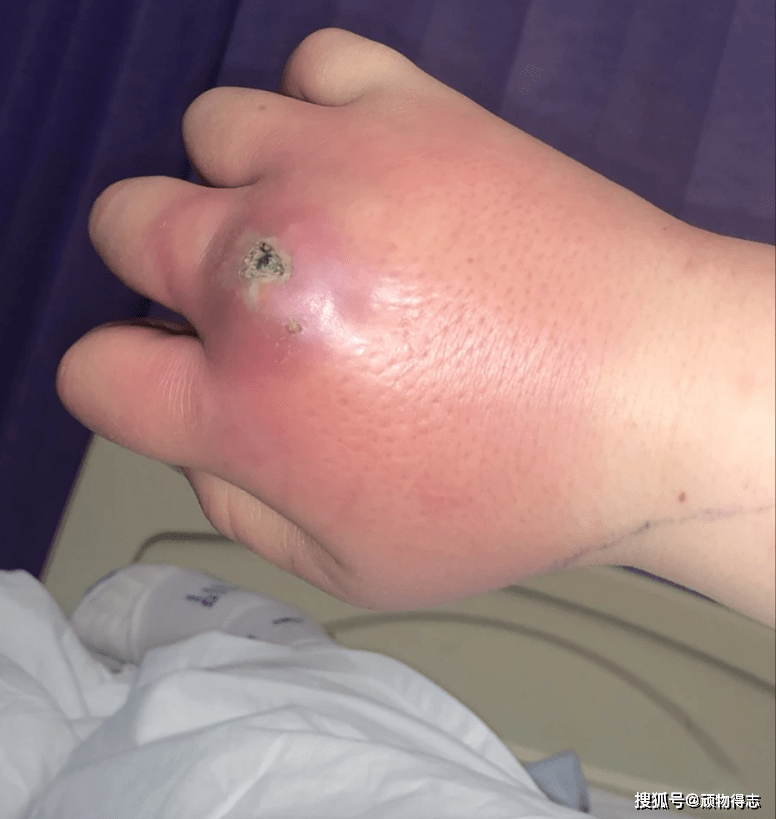 最可怕的噩梦,21岁的护理员被蜘蛛咬了一口,几乎失去了她的手