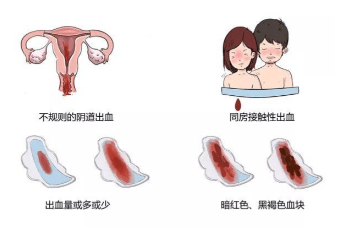 增生物挤破毛细血管造成出血,一些女性在同房后容易出血也有可能是hpv