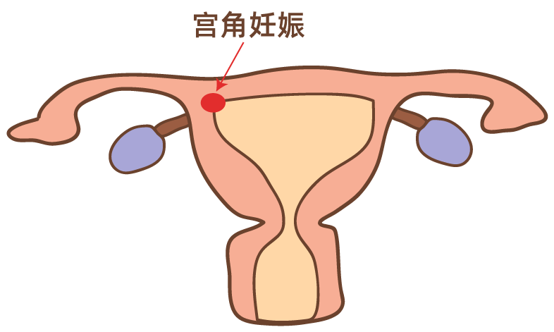 宫角妊娠是一种特殊的宫外孕,一般可通过b超检查诊断.