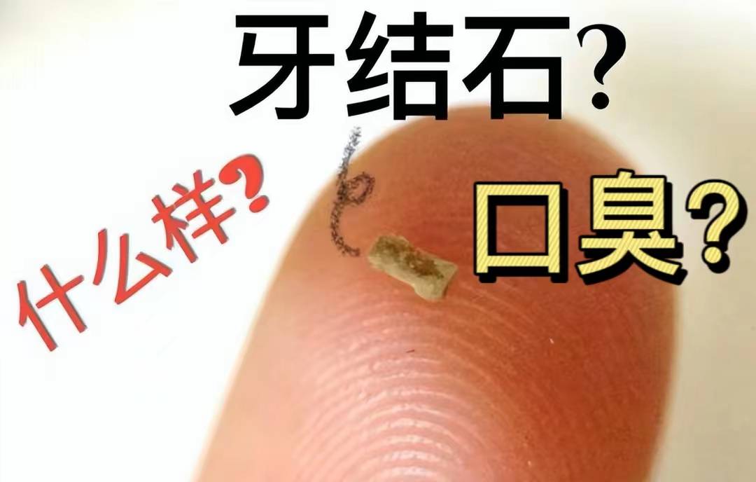 若何去牙结石口臭？康复者自曝亲用好物，只需十天重获清爽口气！