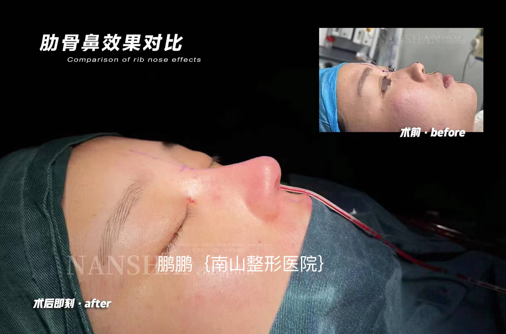 上海南山整形医院鼻整形