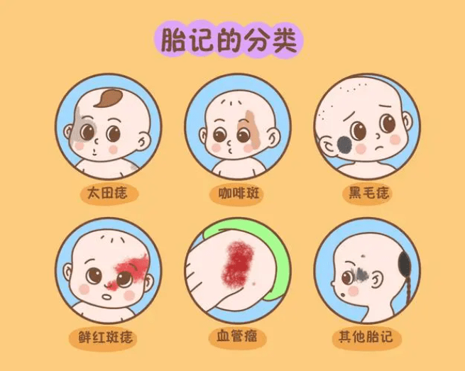宝宝脸上有胎记怎么办?兰州正规胎记医院 时光美容医院丨宝宝脸有胎记怎么治疗最好