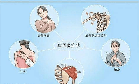 肩周炎——精油保守疗法！