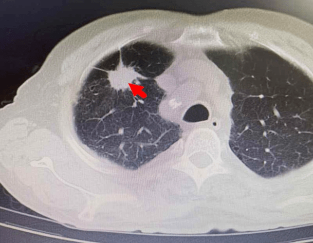 术前ct见右上肺肿瘤