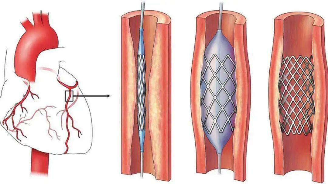 【妍论健康】心脏血管里面放支架,你了解多少?_冠状