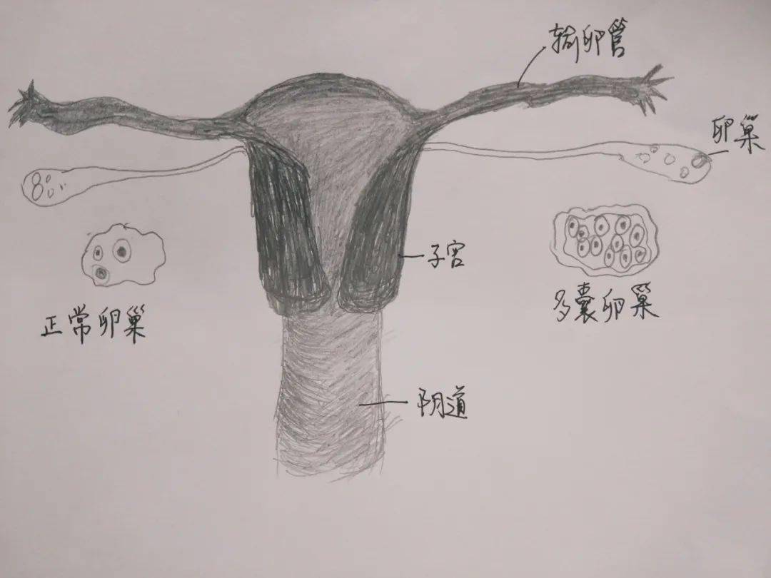 多囊人口渴_多囊卵巢的人不容易老(2)