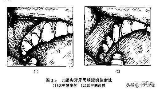 临床各类口腔麻醉讲解