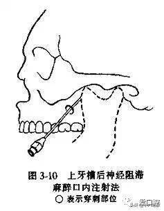 上颌前牙手术):口内法:(4)腭前神经阻滞麻醉将麻药注射入腭大孔或其