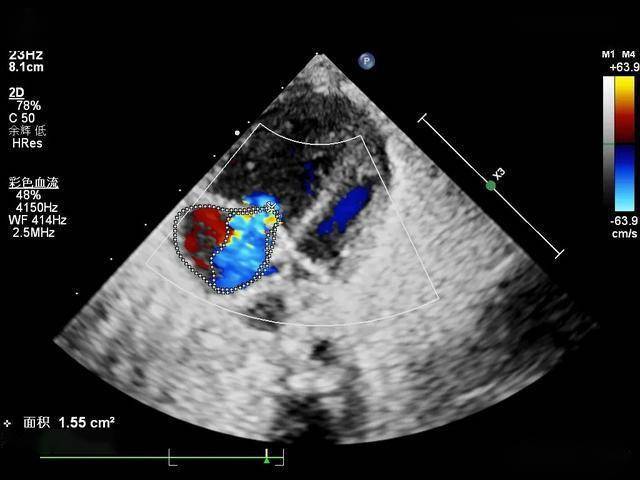 四腔心切面 左房内未见肺静脉开口,右心房室明显增大,cdfi 示三尖瓣