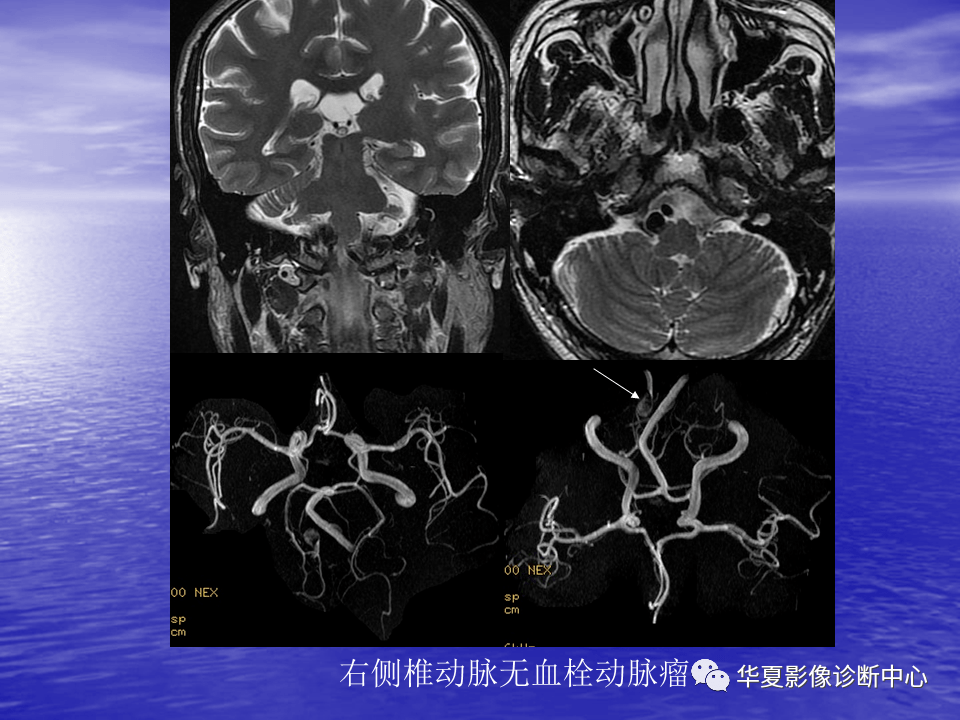 不容错过丨脑血管病变的mri学习