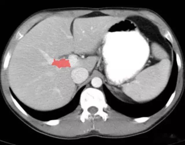 右门静脉(right portal vein)