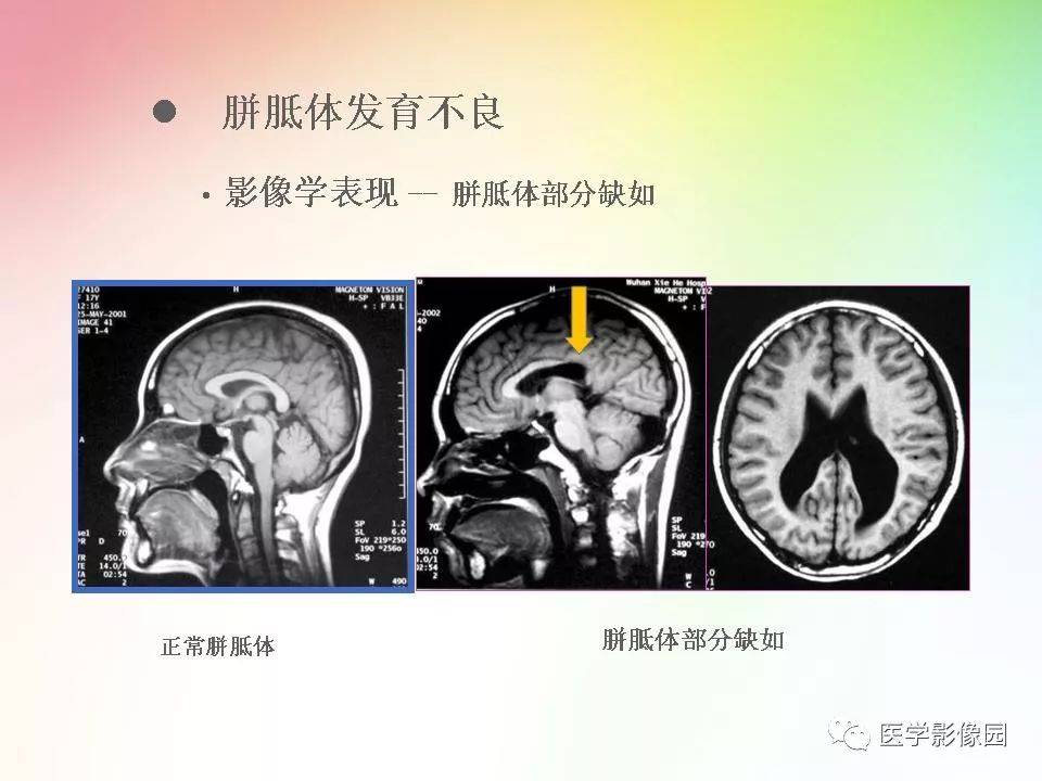 胼胝体病变的影像表现