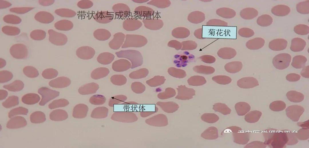 结果:  疟疾; 分型; 三日疟阳性; 红细胞感染率:0.07%.